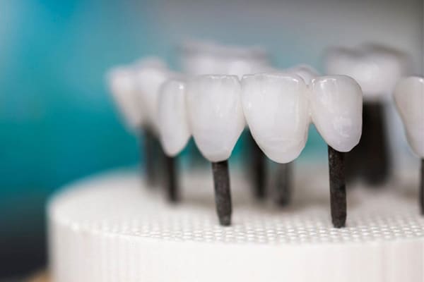 Dental implant crowns displayed on model showing prosthetic tooth restoration options
