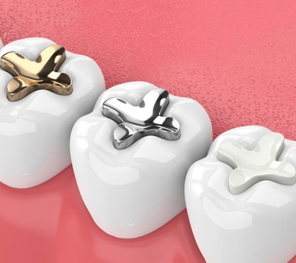Three white tooth models on pink background, two with gold and silver dental crowns, one plain.