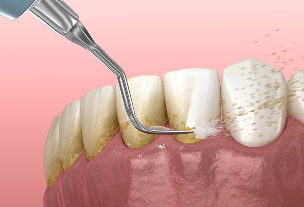 Dental scaling tool removing tartar buildup from tooth surface during professional cleaning procedure.