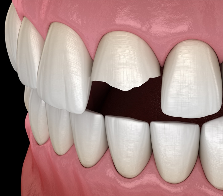 Dental bridge model showing missing tooth replacement between natural teeth on pink gum background.